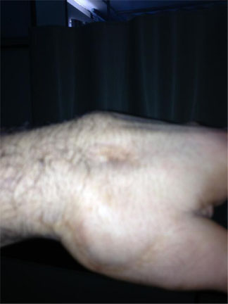 Vitor_belfort_broken_hand_cropped_medium